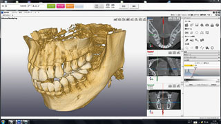 歯科用ＣＴ