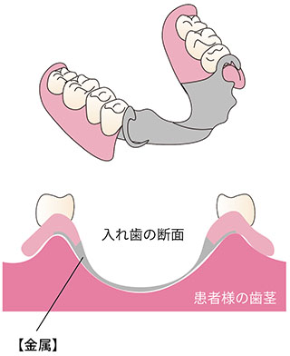 金属床の入れ歯