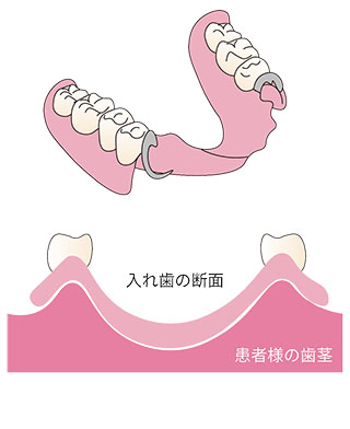 一般的な入れ歯