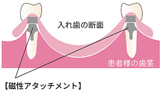 磁性アタッチメント