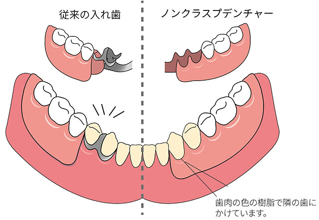 ノンクラスプデンチャー